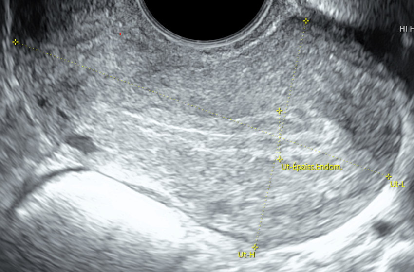 Vue 2d de l'utérus (vue longitudinale)
