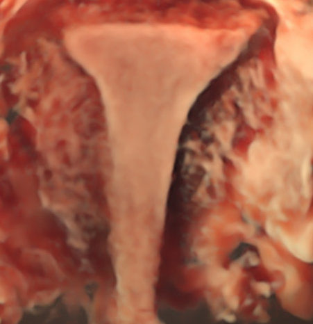 Échographie en 3D de l'utérus